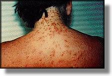 Swimmer with bad jellyfish rash